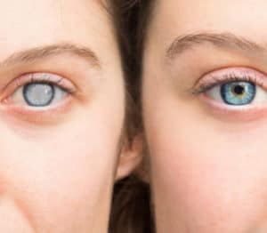 Cataract Surgery Crestview & Okaloosa County