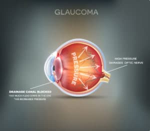 Glaucoma Crestview & Okaloosa County