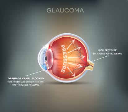 - Alabata Eye Center Glaucoma Crestview & Okaloosa County