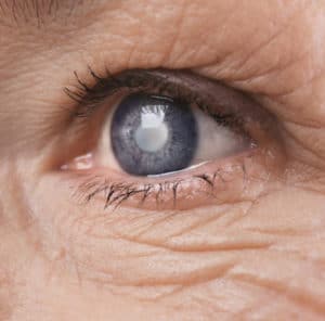 Laser Assisted Vs Traditional Cataract Surgery Crestview & Okaloosa County