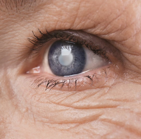 Laser Assisted vs Traditional Cataract Surgery Crestview & Okaloosa County