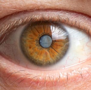 What Are Cataracts? Crestview & Okaloosa County