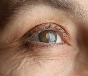 What Are Cataracts Crestview & Okaloosa County