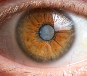 What Are Cataracts? Crestview & Okaloosa County