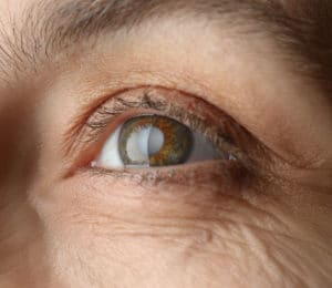 What Are Cataracts? Crestview & Okaloosa County