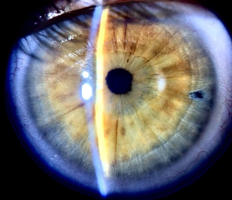 Laser Peripheral Iridotomy for Crestview, Destin, Niceville