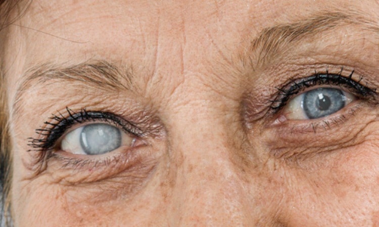 What is the First Sign of Cataracts?