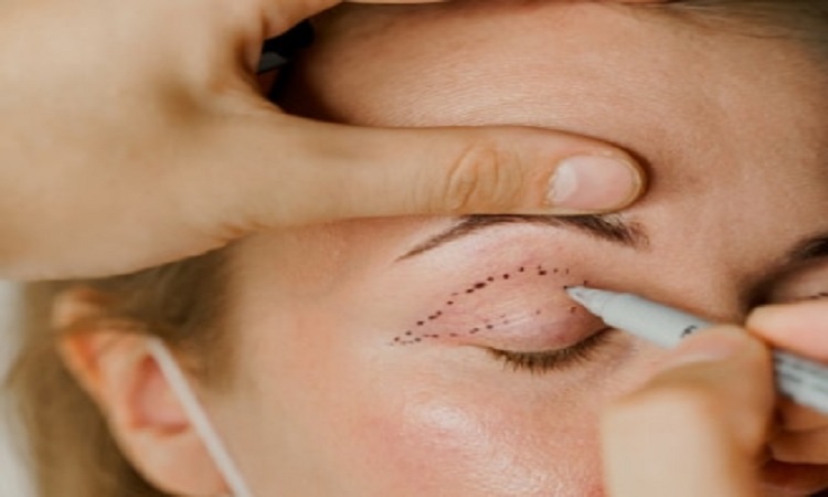 How Long is Recovery From a Blepharoplasty?