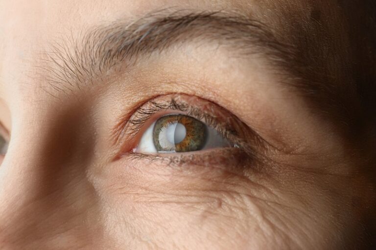 What is the Best Glaucoma Treatment?